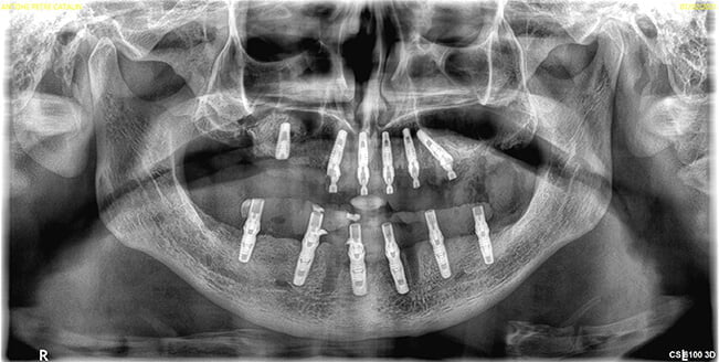 Implanturi Dentare Valcea