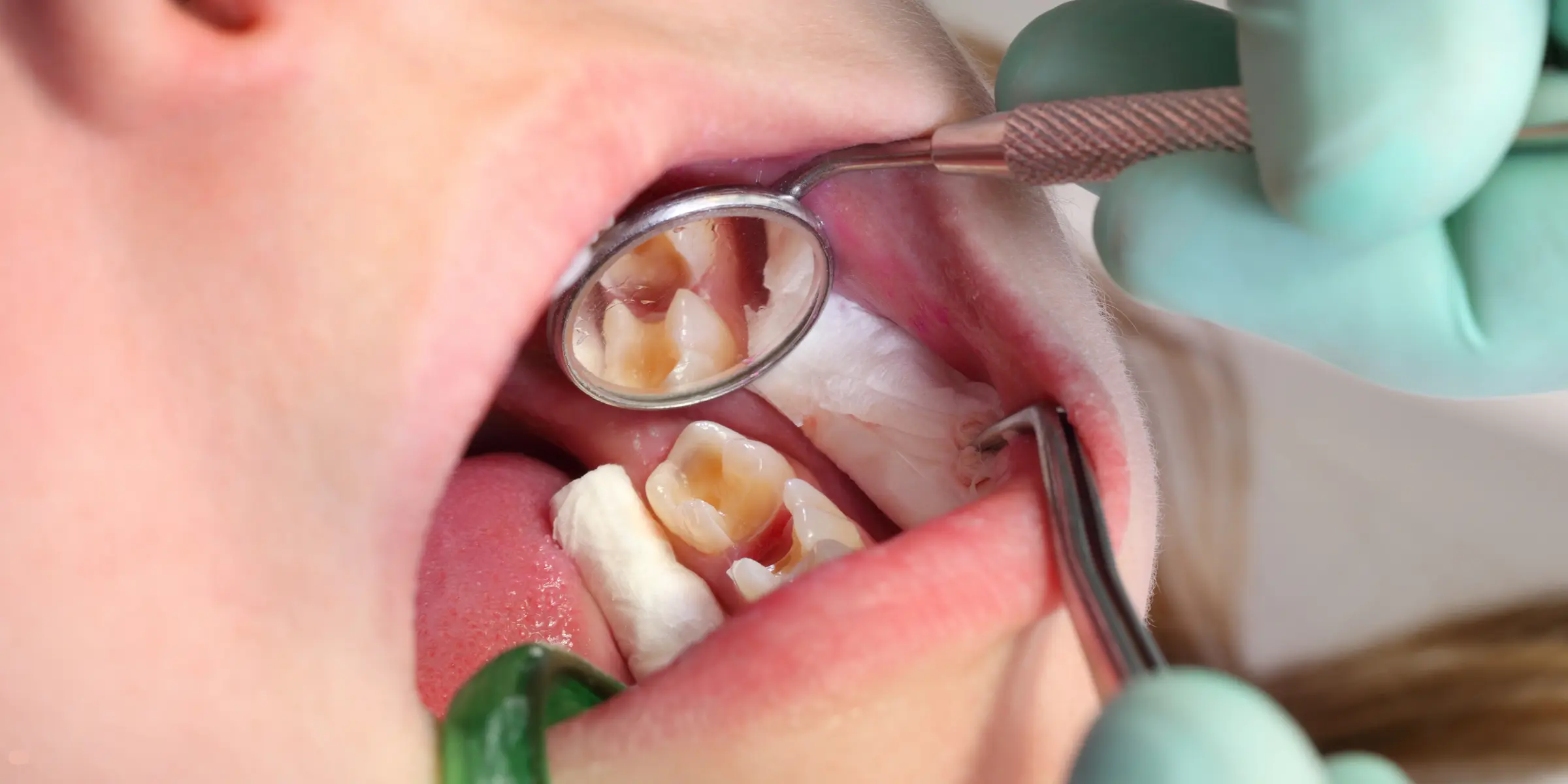 Obturații estetice și plombe dentare la Clinica Pasindora