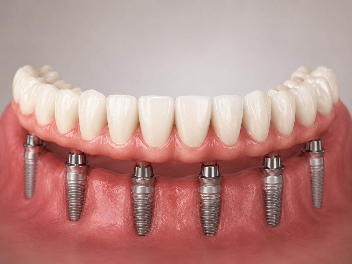 Lucrare dentară fixă pe implanturi