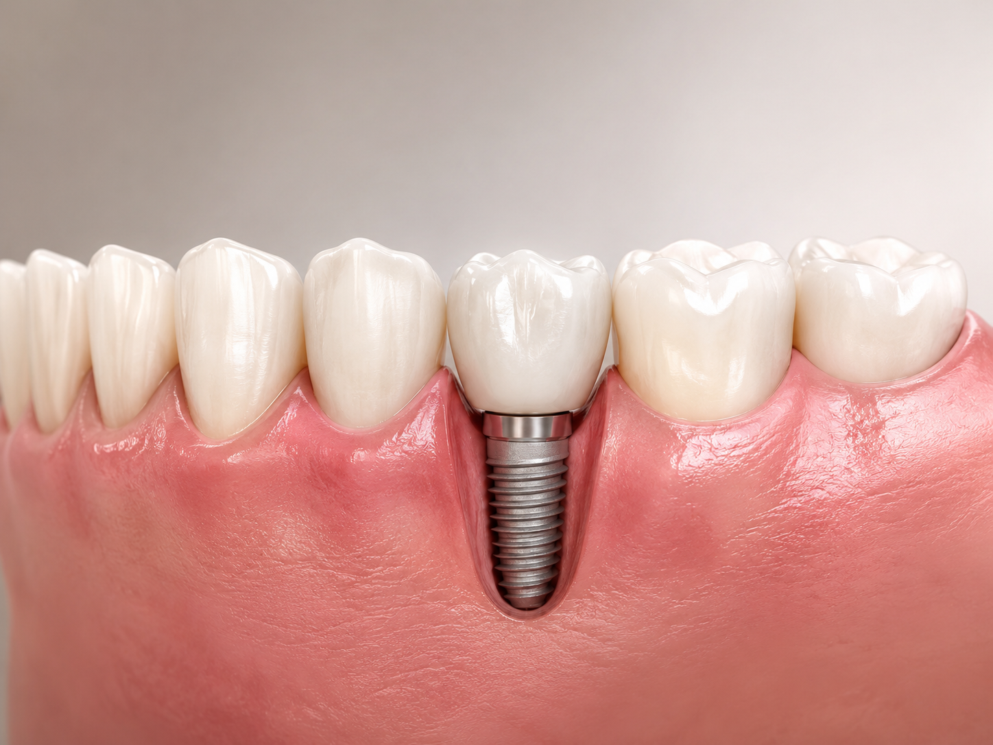 Implant dentar individual