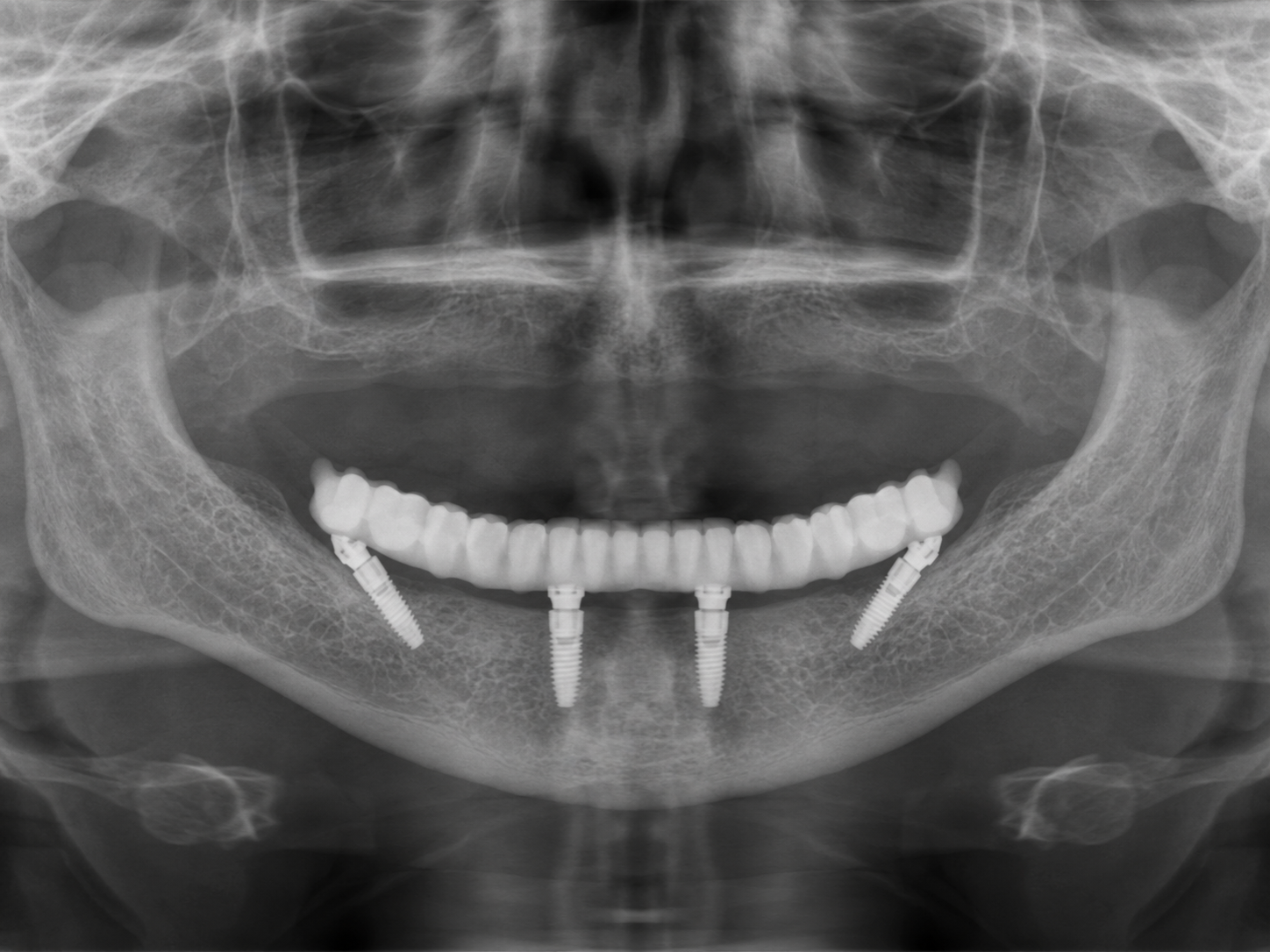 Radiografie All-on-4 cu patru implanturi pentru dantură fixă