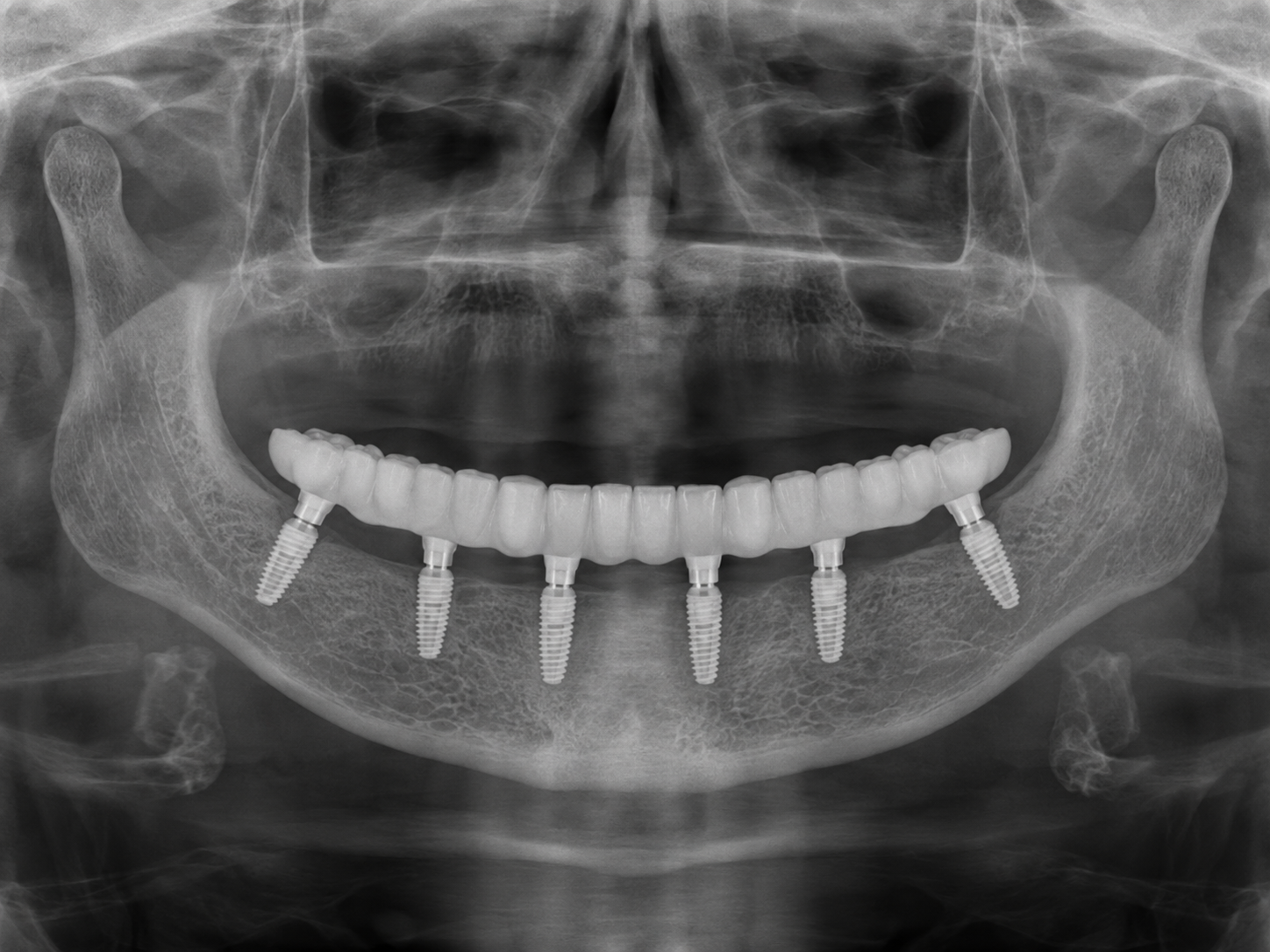 Radiografie All-on-6 cu șase implanturi pentru dantură fixă